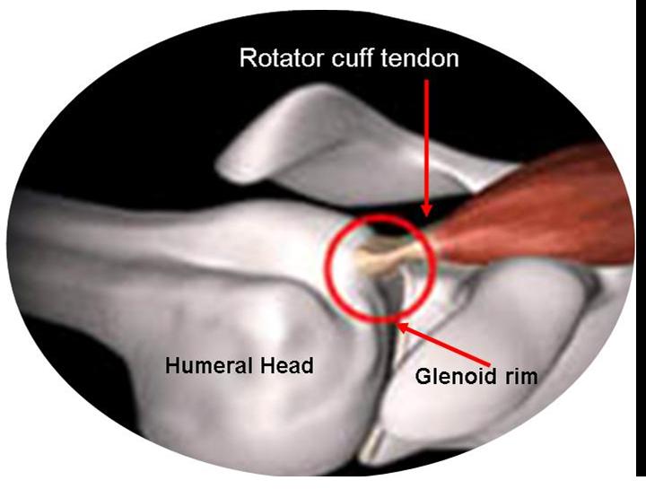 Internal impingement store shoulder